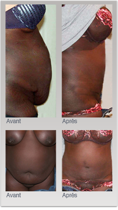 Chirurgie esthétique de l'abdomen,exemple de plastie abdominale