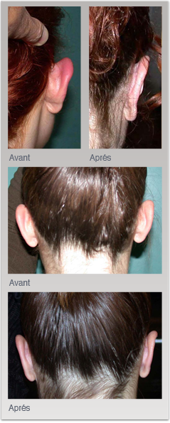 chirurgie esthétiques des orilles/Tranformation chirurgicales des oreilles