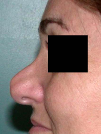 Résultat d'une première rhinoplastie