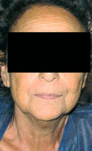 Visage d'une patiente de 70 ans