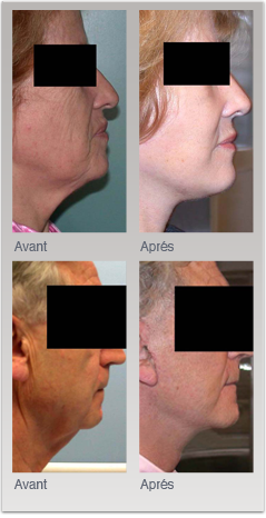 Exemples de lifting cervico-facial chez l'homme et la femme