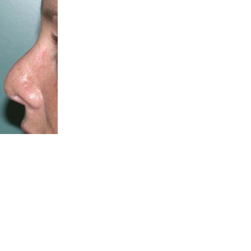 chirurgie-esthetique-chirurgie-secondaire-nez-rhinoplastie-secondaire