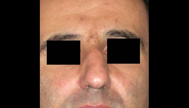 chirurgie-esthetique-interventions-nez-rhinoplasties