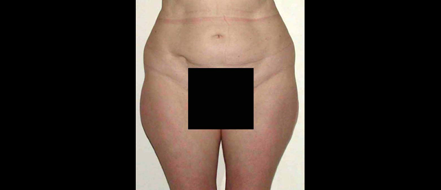 chirurgie-esthetique-interventions-lipoaspirations-liposuccions
