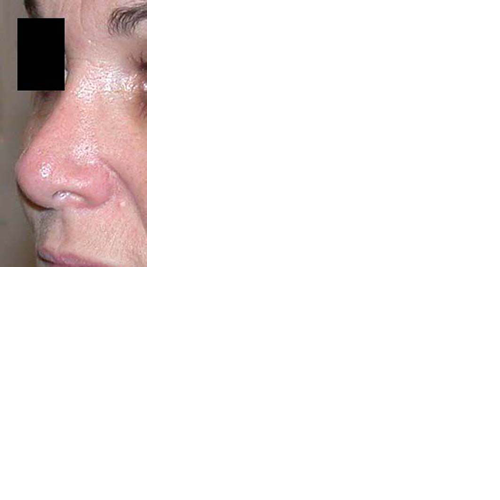 chirurgie-esthetique-chirurgie-secondaire-nez-rhinoplastie-secondaire