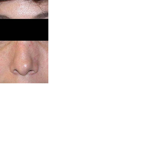 chirurgie-esthetique-chirurgie-secondaire-nez-rhinoplastie-secondaire