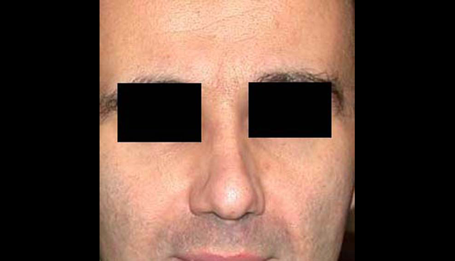 chirurgie-esthetique-interventions-nez-rhinoplasties