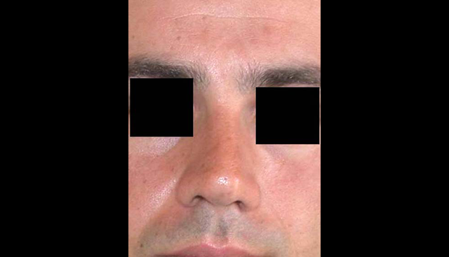 chirurgie-esthetique-interventions-nez-rhinoplasties