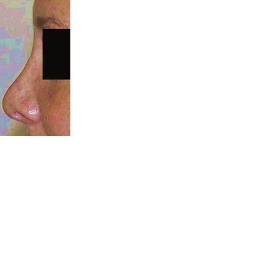 chirurgie-esthetique-chirurgie-secondaire-nez-rhinoplastie-secondaire