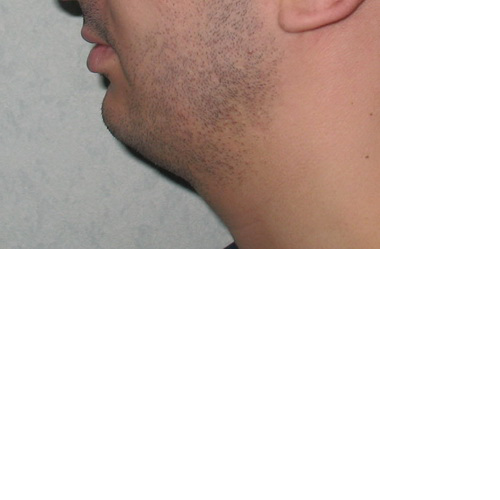 Pas d'angle cervical