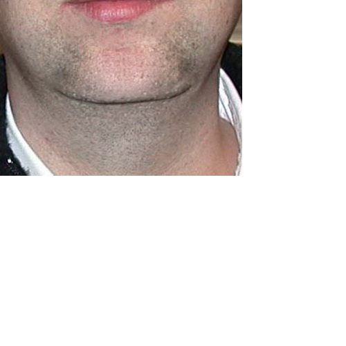 résultat de l'avancée de menton de face