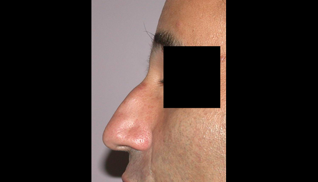 chirurgie-esthetique-interventions-nez-rhinoplasties