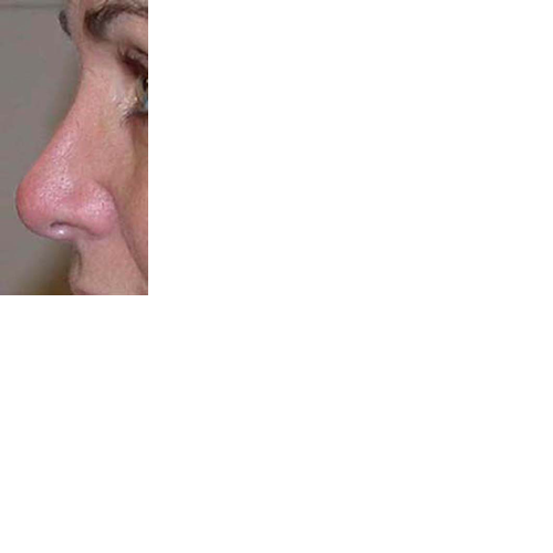 chirurgie-esthetique-chirurgie-secondaire-nez-rhinoplastie-secondaire