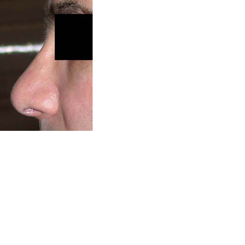 chirurgie-esthetique-chirurgie-secondaire-nez-rhinoplastie-secondaire