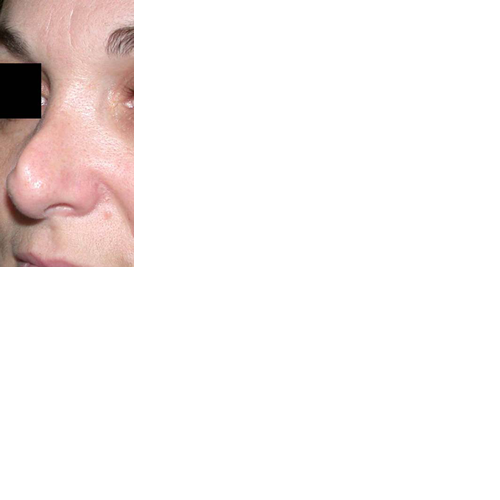 chirurgie-esthetique-chirurgie-secondaire-nez-rhinoplastie-secondaire