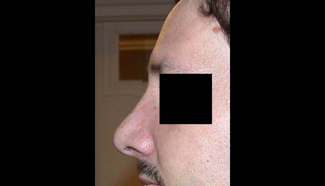 chirurgie-esthetique-interventions-nez-rhinoplasties