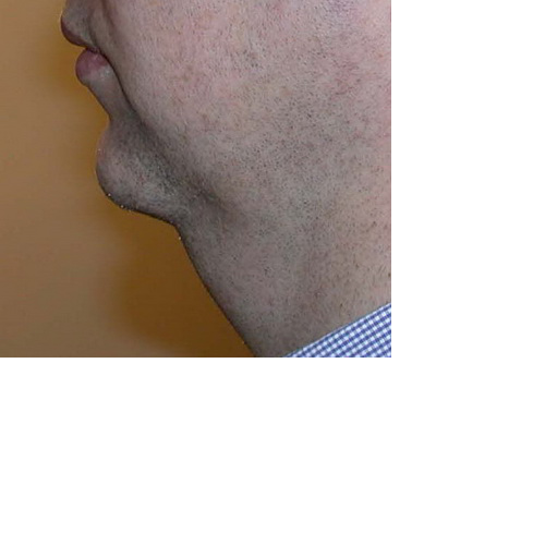 menton en recul et graisse cervicale