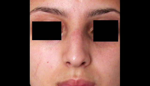 chirurgie-esthetique-interventions-nez-rhinoplasties
