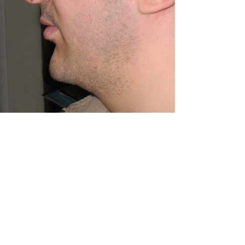 avancée du menton pas pose d'implant