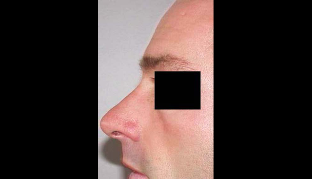 chirurgie-esthetique-interventions-nez-rhinoplasties