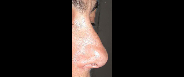 chirurgie-esthetique-interventions-cicatrices-grains-beauté-kystes-tatouages