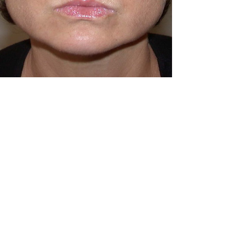 recul du menton vue de face résultat