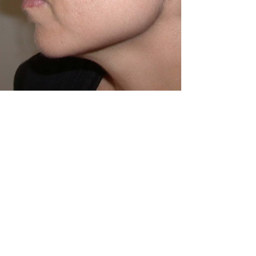 recul du menton vue de profil