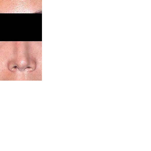 chirurgie-esthetique-chirurgie-secondaire-nez-rhinoplastie-secondaire