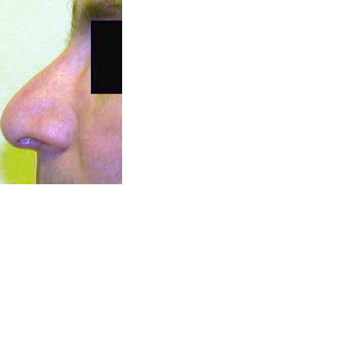 chirurgie-esthetique-chirurgie-secondaire-nez-rhinoplastie-secondaire
