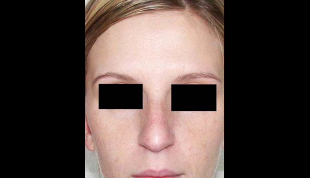 chirurgie-esthetique-interventions-nez-rhinoplasties