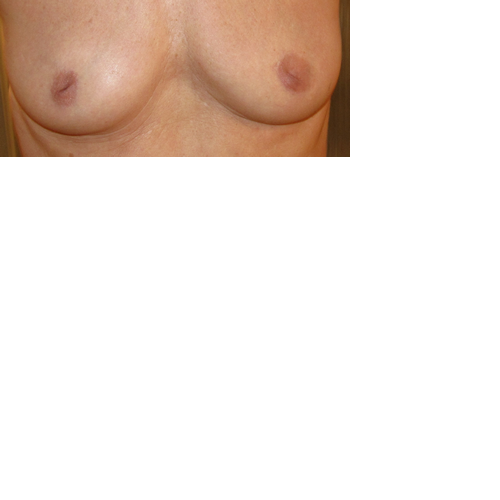 chirurgie-esthetique-interventions-seins-mamelons-rentres