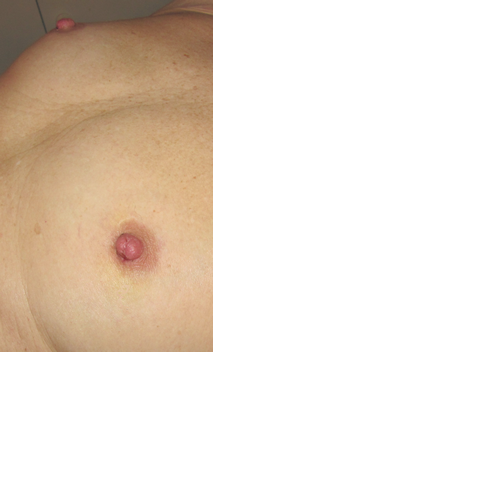 chirurgie-esthetique-interventions-seins-correction-mamelons-rentres