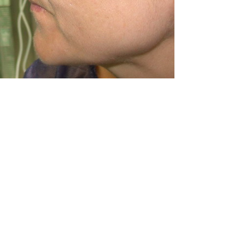 même patiente de profil avant