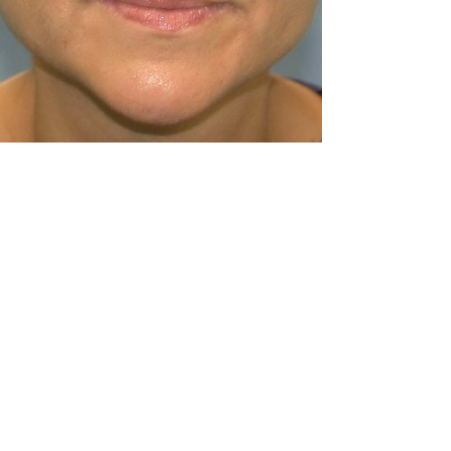 menton en avant vue de face