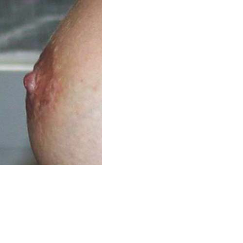 chirurgie-esthetique-interventions-seins-reduction-mamelon